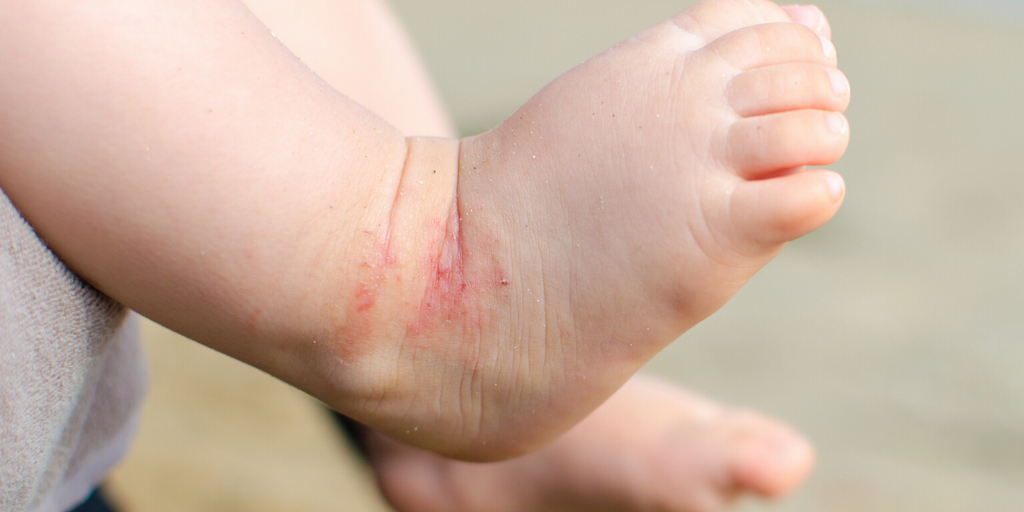 October is National Eczema Awareness Month